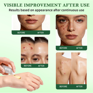 เซรั่มกำจัดสิวสูตรคอลลอยด์ซัลเฟอร์ 20% ระดับมืออาชีพ สำหรับรักษาสิว รอยดำ รอยแดง <span class=keywords><strong>สิว</strong></span>หัวขาว <span class=keywords><strong>สิว</strong></span>หัวดำ <span class=keywords><strong>ผลิตภัณฑ์</strong></span>ดูแลผิว OEM - Product Image 6