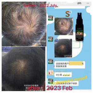 Nuevo Sérum Capilar Natural de Jengibre para el Crecimiento Rápido del Cabello, Spray para el Cuero Cabelludo, Tratamiento para la Caída del Cabello, Detiene la Pérdida de Cabello, con Biotina para Hombre y Mujer - Product Image 2