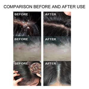 South Moon Sulfur Hair <span class=keywords><strong>Shampooing</strong></span> antipelliculaire rafraîchissant pour soulager les démangeaisons Tinea Capitis réduisant le meilleur <span class=keywords><strong>shampooing</strong></span> séborrhéique pour le cuir chevelu - Product Image 4