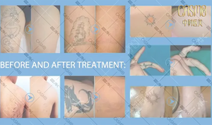 Perawatan Profesional untuk Flek Hitam, Bintik Kopi, Bintik Matahari, Bintik Penuaan, Nevus Ota, Bekas Jerawat, Pemutih Kulit, Penghilang Garis Halus - Product Image 6