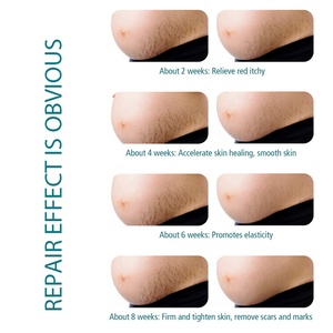 Etiqueta Privada Natural 100% marcas de estiramiento profundo acné cicatriz eliminación crema Anti marcas crema de cuerpo - Product Image 5