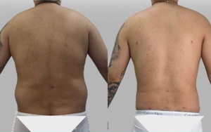 جهاز فيزر لشفط الدهون 980 نانومتر 1470 نانومتر جهاز ليزر ليبوليسيس رفع داخلي - Product Image 6