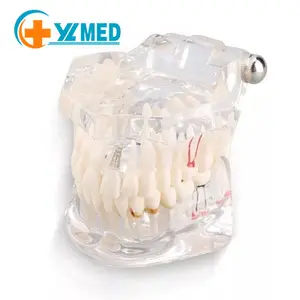 Pathological dental model Removable dental restoration model Transparent movable dental model