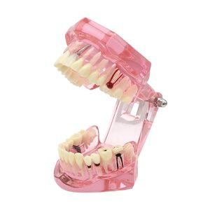 1 modèle dentaire d'étude et de démonstration d'implant dentaire avec restauration, rose - Product Image 6