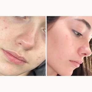 STOP AKNEIK Traitement de l'acné avec de la niacinamide et de l'acide salicylique pour les peaux sujettes à l'acné, tube sans air de 50 ml - Product Image 5