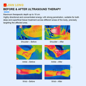 Appareil d'ultrasons thérapeutiques à double fréquence 1 MHz et 3 MHz pour la physiothérapie médicale et le traitement corporel - Product Image 6