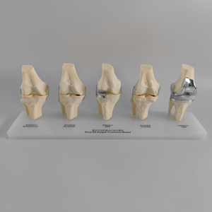 Modèle de comparaison d'implants totaux unicompartimentaux pour l'<span class=keywords><strong>arthrose</strong></span> du genou à 5 stades, modèle de traitement progressif - Product Image 3