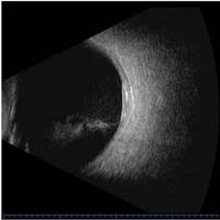 A Scan Biométrie Ophtalmologie SP-2000 A/B Scan Poids léger Biométrie Ophtalmologie Pachymètre ophtalmique