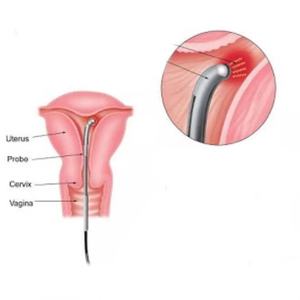 Dispositivo Láser Quirúrgico para Proctología 980nm+1470nm, Corte Láser para Fístula Anal, <span class=keywords><strong>Sinus</strong></span> <span class=keywords><strong>Pilonidal</strong></span>, Hemorroides, para Uso Clínico - Product Image 5