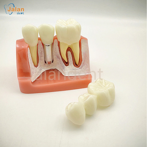 Dentaire Bon Prix Dentaire Enseigner Dent Modèle Caries Dentaires Développement Modèle - Product Image 3
