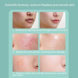 Kräuter-Anti-Akne-Creme |   2-Tage Schnellreparatur Akne-Behandlung |   Salicylsäure-Kräuterextrakt-Formel für Alle Hauttypen |   Privat - Product Image 4