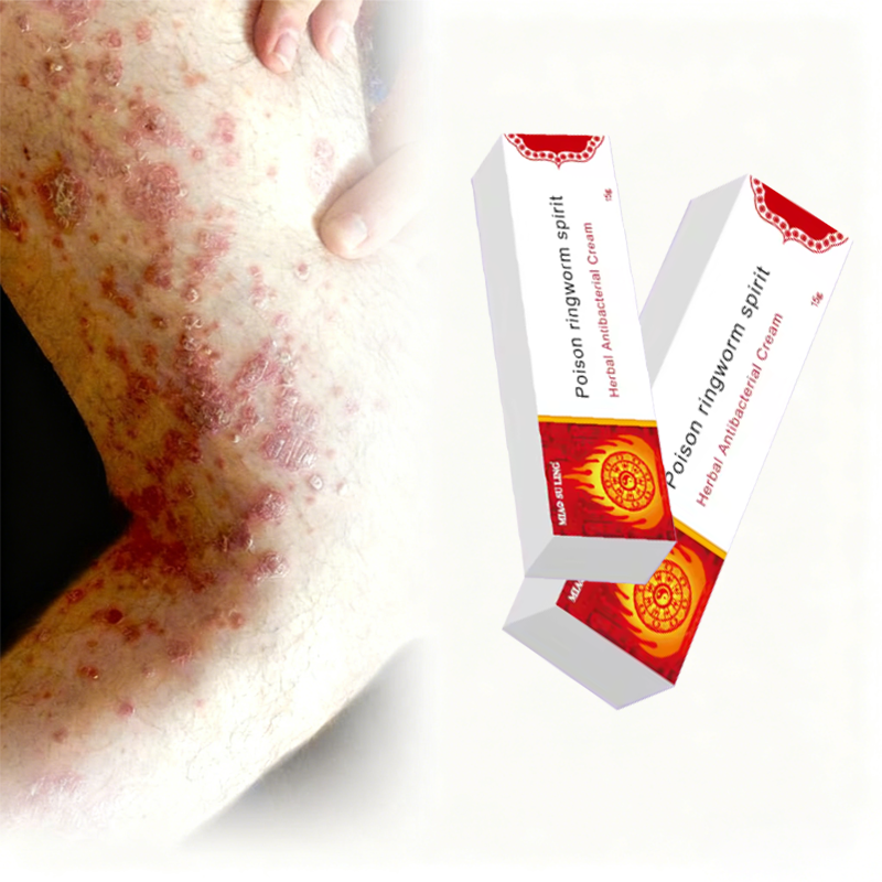 Wholesale Herbal Skin Care Ointment That Relieves Itching, Reduces Redness and Swelling, and Repairs Damaged Skin
