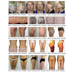 เครื่องนวดกระชับสัดส่วนแบบสุญญากาศ VELA SPRT รุ่นปรับระดับพลังงานได้ 2 ระดับ พร้อมวัสดุ ABS ดีไซน์พกพาสะดวก - Product Image 6