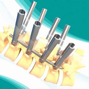 Orthopedisch Medisch Implantaat Vss Verlengde Arm Minimaal Invasieve Systeem Fabrikant Directe Verkoop - Product Image 5
