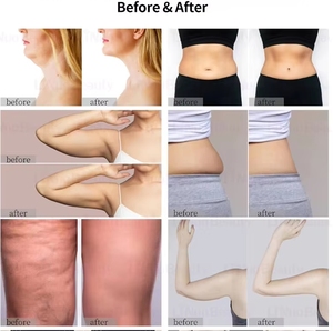 Máquina de Modelado Corporal Térmico <span class=keywords><strong>Onda</strong></span> PRO Aesthetic, Múltiples Modos de <span class=keywords><strong>Trabajo</strong></span> para Mejorar la Elasticidad de la Piel y Dar Forma al Cuerpo - Product Image 4