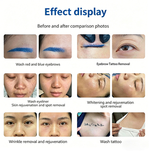 La nouvelle version 3.0 du Pico Pro, appareil de beauté non invasif et indolore pour l'élimination des sourcils et des tatouages. - Product Image 5