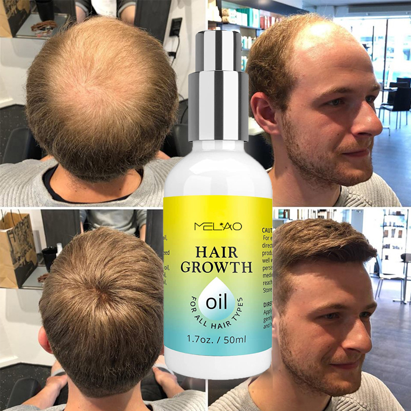 Полностью натуральное органическое масло для роста волос MELAO, против выпадения волос, против облысения, масло для роста волос, эссенция частной марки для женщин и мужчин