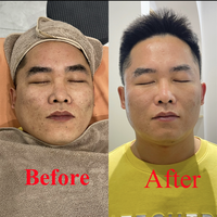 Sérum Professionnel Microneedling Anti-Taches Pigmentaires Bio Peeling Masque Micro-Aiguilles aux Algues Marines