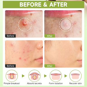 Produk Perawatan Kecantikan Pengobatan Jerawat, Plester Jerawat Hidrokoloid yang Dapat Disesuaikan, Niacinamide, Asam Salisilat, Plester Jerawat - Product Image 4