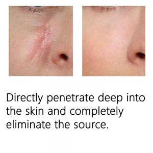 Crema Avanzada para Cicatrices, la Mejor Crema para Cicatrices Antiguas, Queloides y TKA, para Venta al por Menor - Product Image 2