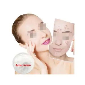 San Pham Tot Nhat Acne Removal Cream Anti Acne Spots Control Repair Acne Marks Gel Face Care