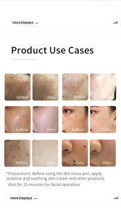 Instrument Portable d'Élimination des Taches Machine de Cautérisation Électrique Dispositif d'Élimination des Grains de Beauté Stylo de Détouage de la Mélanine - Product Image 4