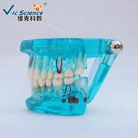Restauration avec implant modèle de dents dentaires modèle d'enseignement des sciences médicales modèle de dents humaines