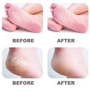 Éliminateur Électronique de Callosités Rechargeable Haute Efficacité à Prix Usine pour des Pieds Plus Lisses – Râpe Pédicure