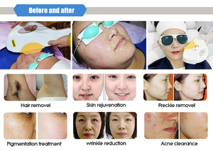 <span class=keywords><strong>CE</strong></span> Được Phê Duyệt Đa Chức Năng Máy Làm Đẹp Elight + Diode 808nm Laser + Q Chuyển Nd Yag Laser + <span class=keywords><strong>RF</strong></span> - Product Image 4