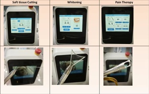 <span class=keywords><strong>Laser</strong></span> <span class=keywords><strong>Dental</strong></span> Multifuncional 3 em 1, <span class=keywords><strong>Laser</strong></span> de Diodo para Clareamento <span class=keywords><strong>Dental</strong></span>, Corte de Tecidos Moles, Fisioterapia <span class=keywords><strong>Dental</strong></span> e Cirurgia <span class=keywords><strong>Dental</strong></span> - Product Image 4
