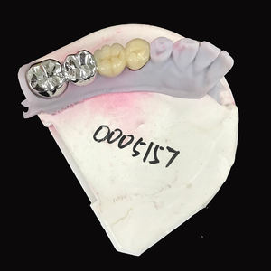 Restauración <span class=keywords><strong>fija</strong></span> Laboratorio dental asequible <span class=keywords><strong>Precio</strong></span> de China Puentes de corona de cerámica de metal <span class=keywords><strong>Precio</strong></span> barato Pfm - Product Image 5