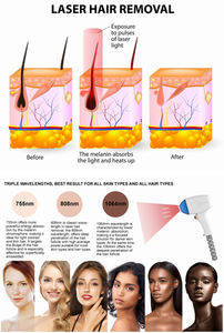 Máquina Portátil 2 en 1 para Depilación y Eliminación de Tatuajes con Tecnología de Picosegundos, Pantalla de 10.4 Pulgadas, Material ABS - Product Image 6