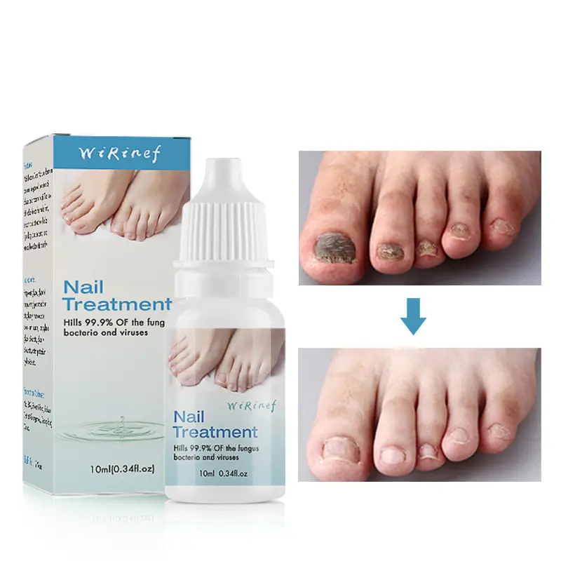 Herbal extract Anti Infection Nail Treatment Essence Toe Nail Fungus Removal Feet Care Nail Foot Whitening Bright customized