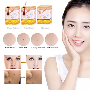전자 하이테크 스킨 태그 제거기 두더지 사마귀 제거 플라스 펜 검은 반점 사마귀 제거기 피부 미용
