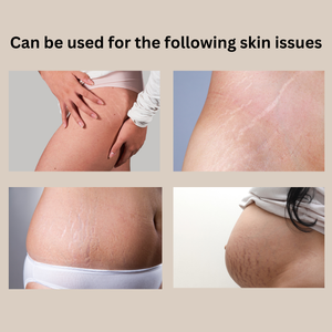 美白ニキビススキ除去ストレッチマーク除去クリーム2025年妊娠用 - Product Image 4