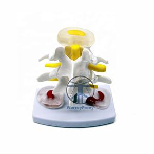 עמוד השדרה הרפואית אנדוסקופ אנדוסקופי השדרה ניתוח הוראת דגם transforaminal אנדוסקופ חולים עמוד השדרה דגם - Product Image 4