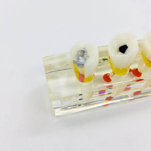 Riparazione della polpa dentale modello orale per la visualizzazione e la comunicazione - Product Image 5