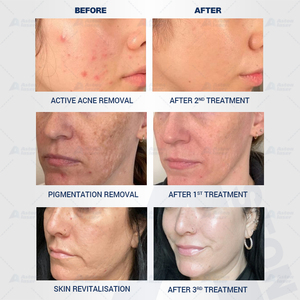 Laser Thulium sóng 1927nm điều trị nám, Laser Erbium Thulium vi điểm 1927 & 1550, Laser không vi điểm 1550 & 1927 - Product Image 4