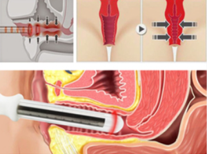 Láser <span class=keywords><strong>de</strong></span> Diodo <span class=keywords><strong>de</strong></span> Ginecología Clase IV <span class=keywords><strong>de</strong></span> 1470nm en Oferta, Tratamiento <span class=keywords><strong>de</strong></span> Ginecología y Urología - Product Image 4