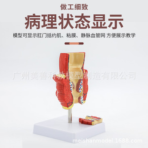 Modèle de hémorroïdes rectales et de lésions colorectales ; hémorroïdes rectales internes et externes et modèle anorectal ; pathologie rectale. - Product Image 4