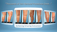 980nm 1470nm Diode Laser Endovenous Varices EVLT Chirurgie Enlèvement Machine Traitement Jambes Varices