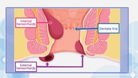 Système d'ablation Diodo Laser 980nm 1470nm moyen le plus efficace et le plus sûr de traiter les hémorroïdes/dispositif de traitement des hémorroïdes