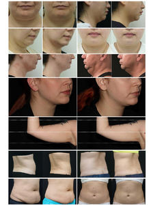 เครื่องสลายไขมันแบบสองหัวจับ รุ่นปี 2026 - Product Image 6