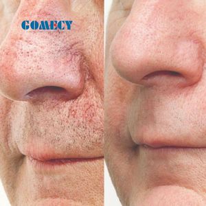 Peralatan Kecantikan Laser 15W 980Nm untuk Penghapusan Pembuluh Darah Merah dan Penghapusan Spider Veins di Wajah - Product Image 3