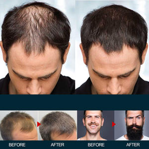 Solución para el Crecimiento del Cabello, Efecto Significativo Después del Uso, Despierta los Folículos Capilares Dormidos, Tratamiento para el Crecimiento del Cabello, Éxito en Ventas en Tiktok - Product Image 5