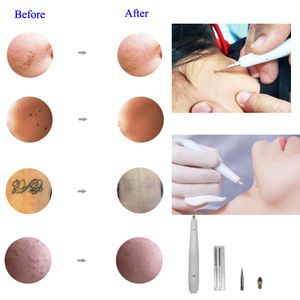 Caneta Portátil Auro para Remoção de Verrugas e Sinais, Máquina de Eletrocautério para Remoção de Peles Mortas - Product Image 5