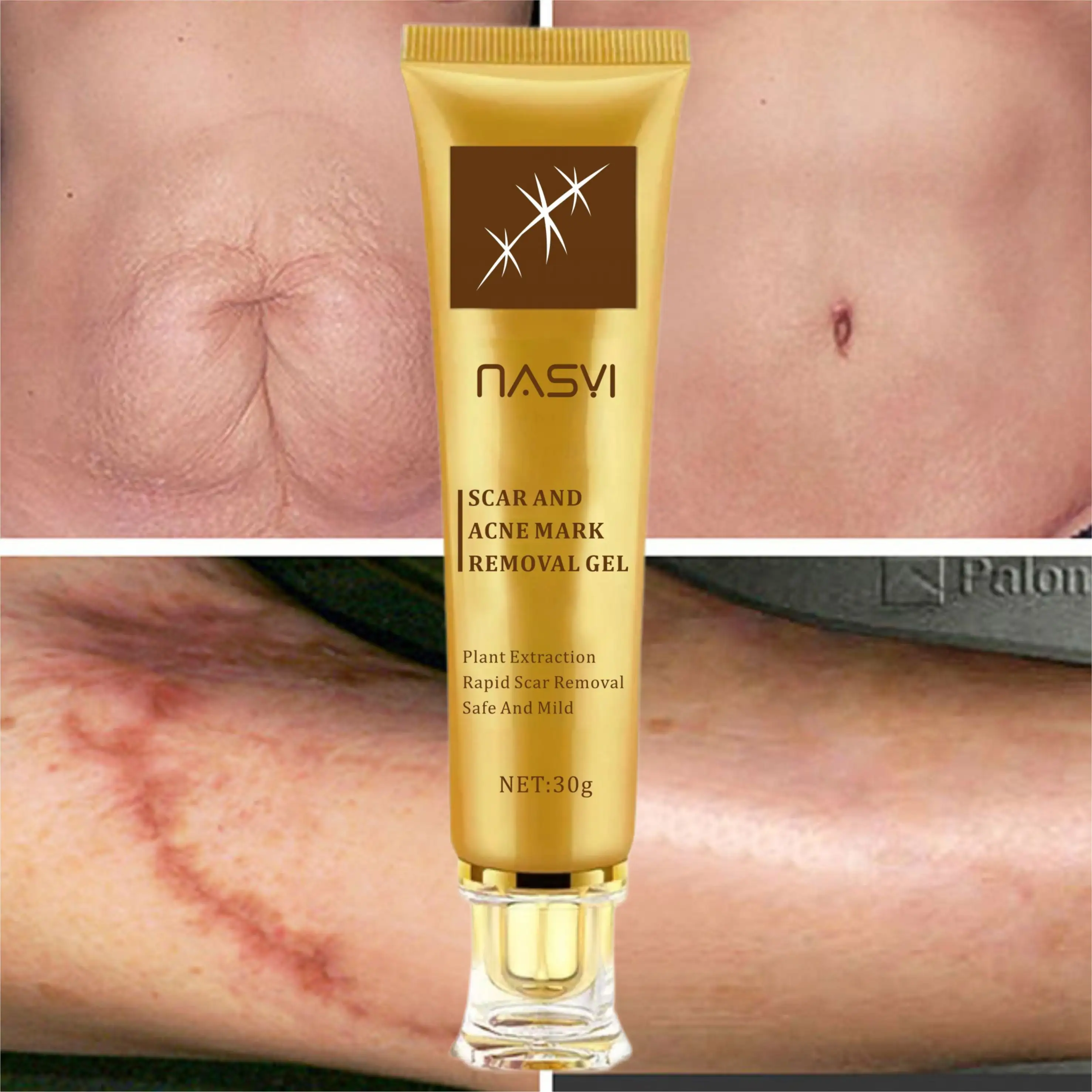 natural scar removal cream for new old scars herbal acne scar stretch marks removal gel pigmentation corrector whitening cream