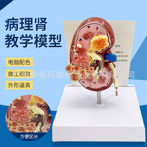 Modelo anatómico de riñón humano, modelo de riñón patológico, especialidad de urología y andrología. - Product Image 2