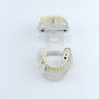 Implant dentaire détachable pathologique avec nerfs dent résine PVC pont couronne modèle de démonstration modèle de Construction