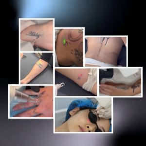 Système Pico multi-longueurs d'onde professionnel, 4 embouts <span class=keywords><strong>pour</strong></span> l'élimination des tatouages, la correction des sourcils, le raffinage des pores et l'éclaircissement, utilisation en salon - Product Image 4